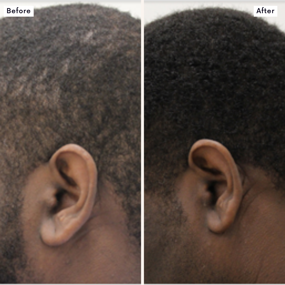 Hair Growth Treatment