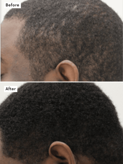 Hair Growth Treatment